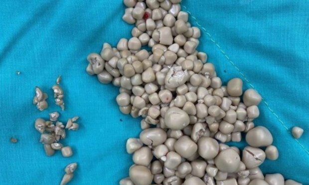 У 20-летней женщины на Тайване удалили более 300 камней в почках, фото из свободных источников