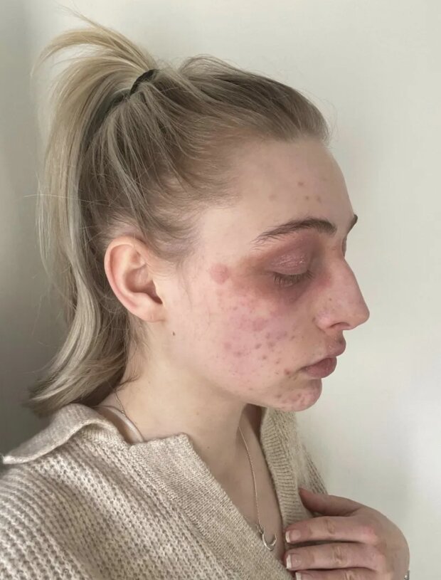 Харли Уостон после процедуры, фото из соцсетей