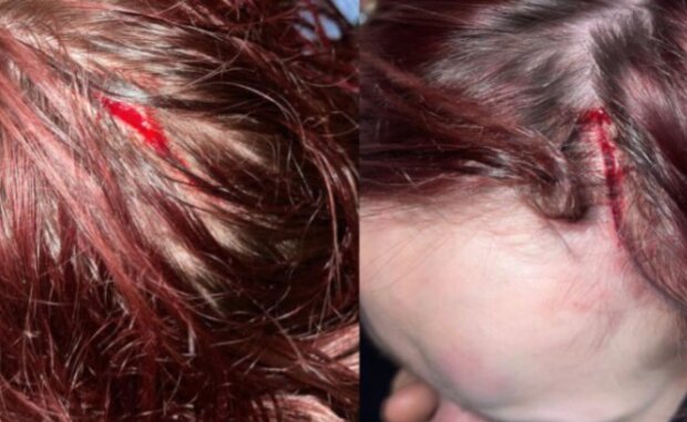 Результат побиття дівчини співробітником ТЦК