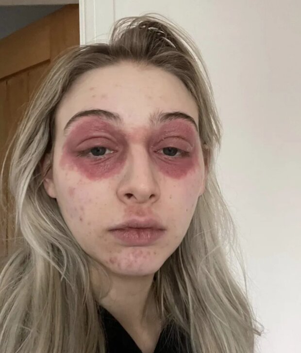 Харли Уостон после процедуры, фото из соцсетей