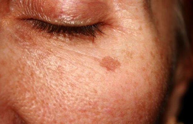 Пигментные пятны, фото из свободных источников